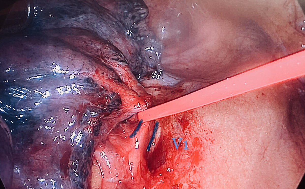 AndresObesoMD's tweet photo. #TipOfTheDay. This is my last VATS right S1 anatomical segmentectomy. It’shighly advisable to dissect distally the subsegmentary arterial branches A1a and A1b in order to identify also A2 recurrent artery. This posterior branch must be always preserved.
@SECTtoracica @gect_separ https://t.co/utz9DcvosF