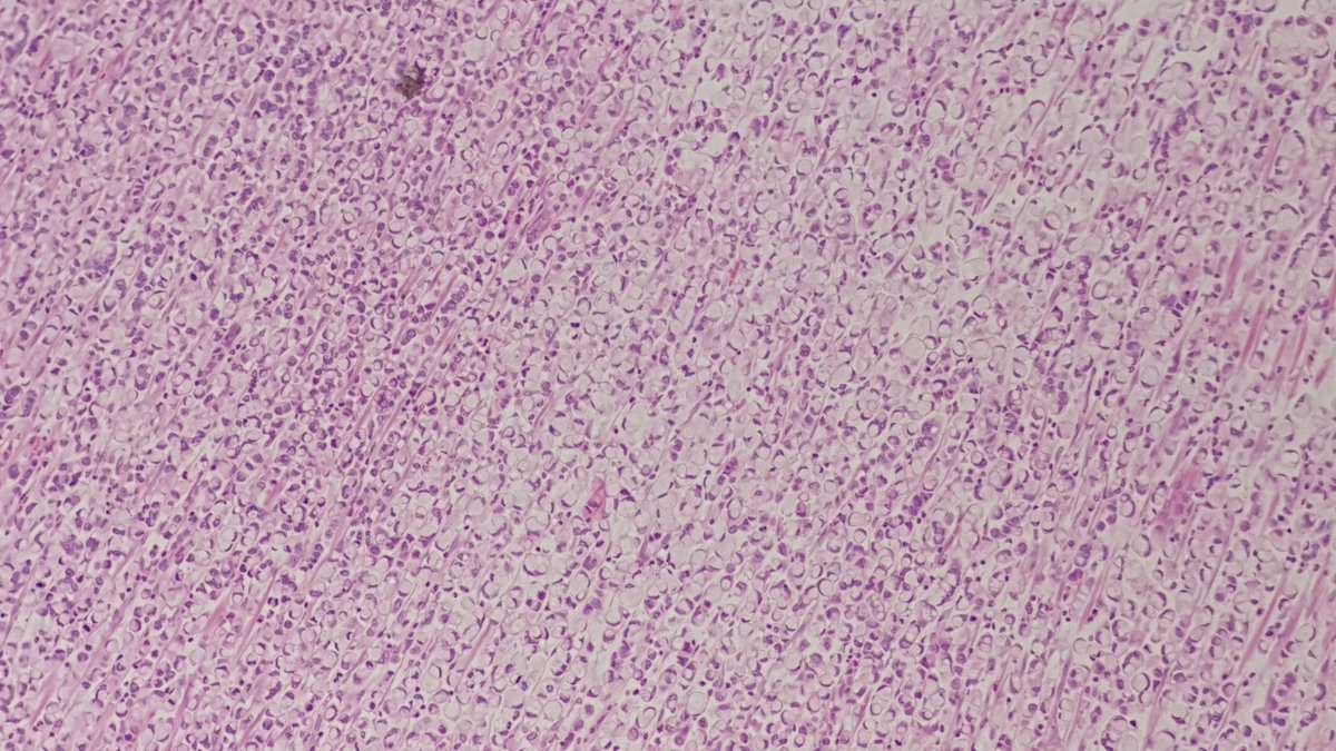 ozkanaydin1986's tweet photo. Stomach, signet ring cell carcinoma 💍💍 @ozkanaydin1986 #gispath #gispathology https://t.co/PcYVeXD8Eq