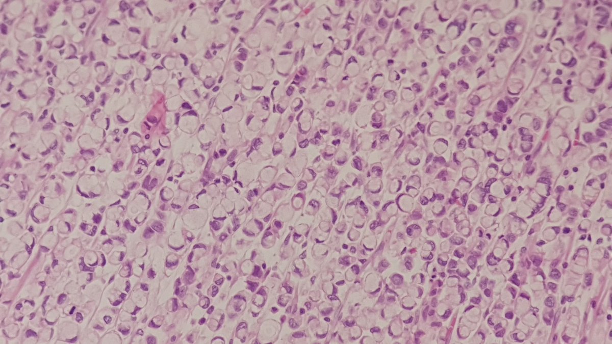 ozkanaydin1986's tweet photo. Stomach, signet ring cell carcinoma 💍💍 @ozkanaydin1986 #gispath #gispathology https://t.co/PcYVeXD8Eq