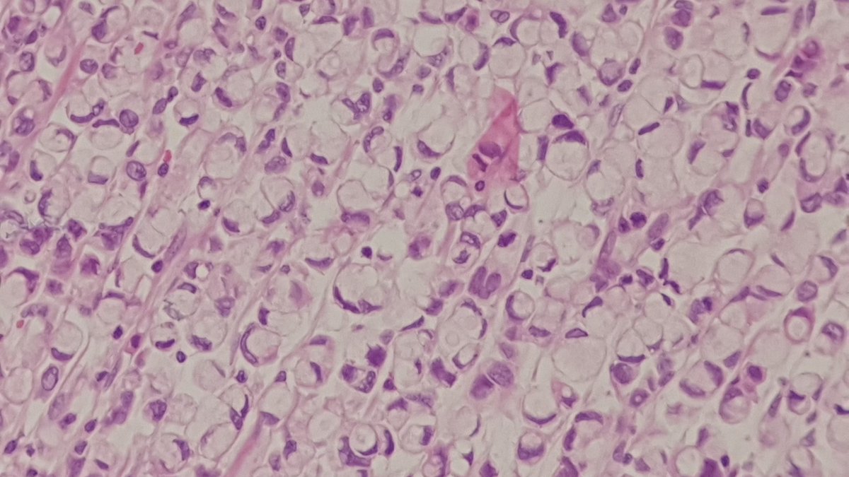 ozkanaydin1986's tweet photo. Stomach, signet ring cell carcinoma 💍💍 @ozkanaydin1986 #gispath #gispathology https://t.co/PcYVeXD8Eq