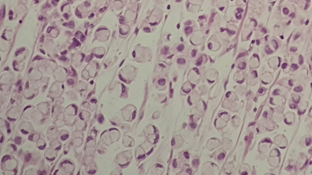 ozkanaydin1986's tweet photo. Stomach, signet ring cell carcinoma 💍💍 @ozkanaydin1986 #gispath #gispathology https://t.co/PcYVeXD8Eq