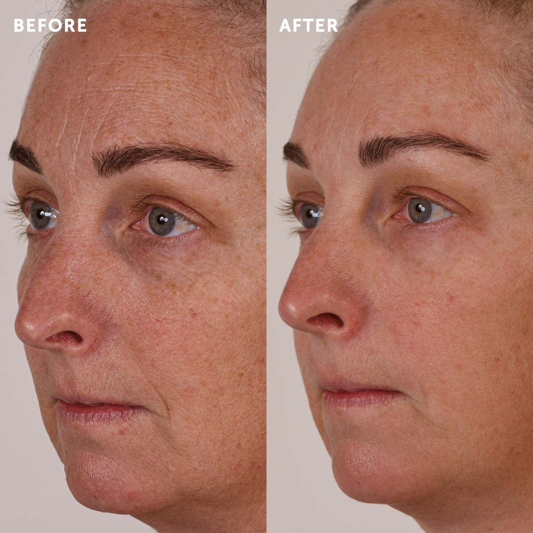 SilcSkin's tweet image. Use SilcSkin medical-grade silicone pads to reduce the appearance of wrinkles. And now save 10% off your purchase by using code SPRING2022 at checkout.

#undereyebags #preventativebotox #thefaceliftalternative #collageninduction #wrinklesbegone #wrinklereducer