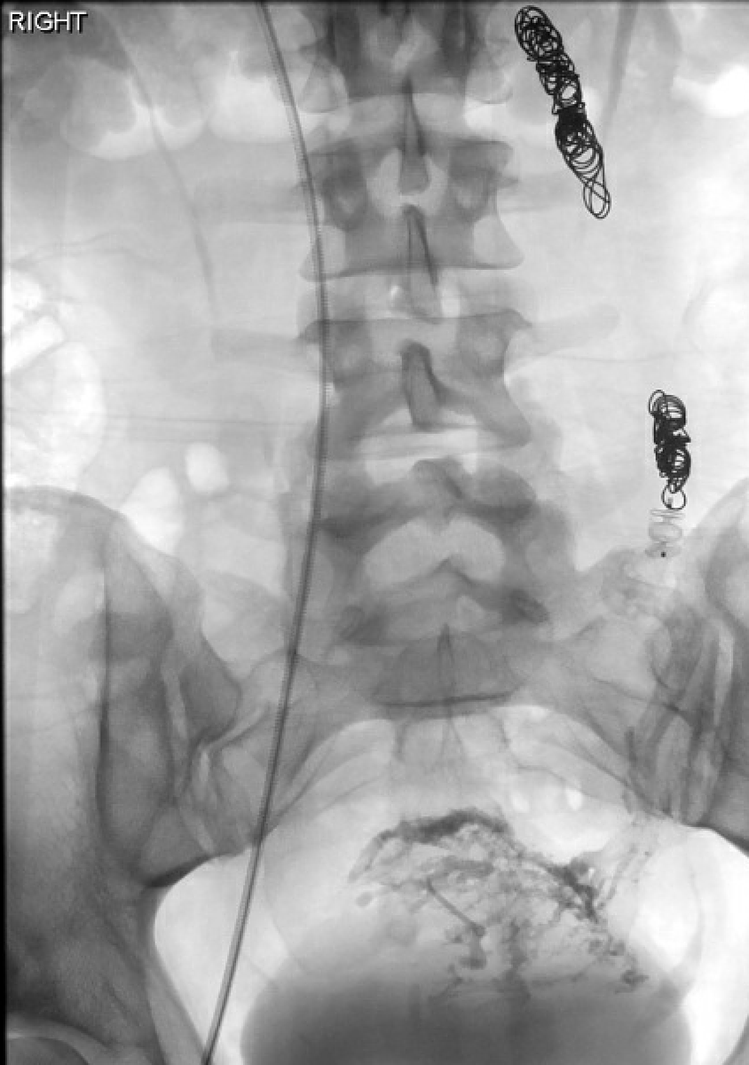 Pelvic venous congestion/insufficiency...under-dx'ed source of pelvic and abdominal pain for women. This pt cried'happy tears' bc she had to fight for 3 years to get the diagnosis and get this procedure. Great post pic with sclerosant in the varices! @chrisrstark @AlbanyIR