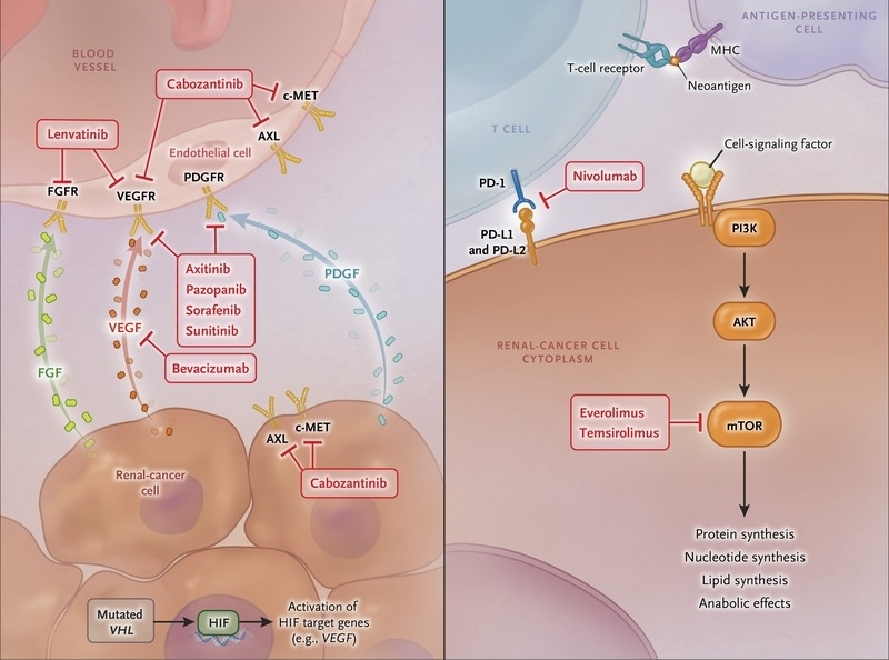 OAE_JCMT's tweet photo. #CancerTwitter #mRCC #VEGF #PredictiveBiomarker #IndividualizedTherapy #Immunotherapy #Prognosis
Today we share with you #Review "Individualized therapy for metastatic renal cell carcinoma" by Dr. Izabelle Wood's team.
👉👉Online version:
https://t.co/h0c2mXTfLA https://t.co/yVi5AxdfBc