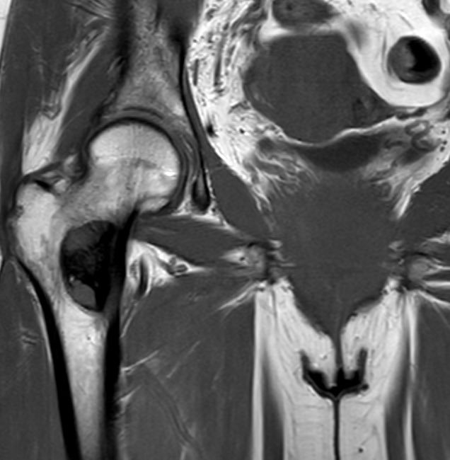 Liposclerosing myxofibrous tumour - in view of the potential risk of malignant transformation (10-16%, as quoted in the literature), specialist orthopaedic input is recommended.