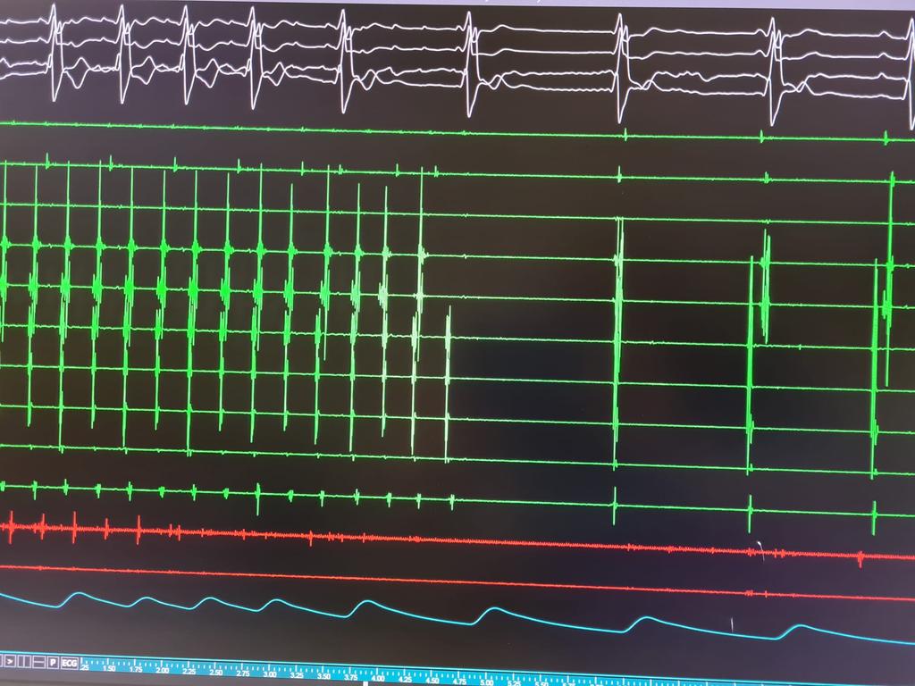 Giulio Falasconi, MD (@drfalasconi) on Twitter photo LA flutter ablation. Successful anterior mitral line guided by LA Wall thickness. Personalized ablation way! <a href="/DrBerruezo/">DrAntonioBerruezo</a> <a href="/ADAS3D/">ADAS3D Medical</a> <a href="/Clinica_Teknon/">Centro Médico Teknon</a> <a href="/OpenHeart_EU/">OpenHeart Foundation</a> <a href="/Davidsotoiglesi/">David soto-iglesias</a> <a href="/diegopenela1/">diego penela</a> <a href="/Dr_SanAntonio/">Rodolfo San Antonio</a> <a href="/daniviverosf/">Daniel Viveros</a> <a href="/Dra_Scherer/">Claudia Scherer</a> <a href="/JAldereteM/">José Alderete M</a> <a href="/julio93383971/">Julio Martí Almor</a> LA flutter ablation. Successful anterior mitral line guided by LA Wall thickness. Personalized ablation way! <a href="/DrBerruezo/">DrAntonioBerruezo</a> <a href="/ADAS3D/">ADAS3D Medical</a> <a href="/Clinica_Teknon/">Centro Médico Teknon</a> <a href="/OpenHeart_EU/">OpenHeart Foundation</a> <a href="/Davidsotoiglesi/">David soto-iglesias</a> <a href="/diegopenela1/">diego penela</a> <a href="/Dr_SanAntonio/">Rodolfo San Antonio</a> <a href="/daniviverosf/">Daniel Viveros</a> <a href="/Dra_Scherer/">Claudia Scherer</a> <a href="/JAldereteM/">José Alderete M</a> <a href="/julio93383971/">Julio Martí Almor</a>