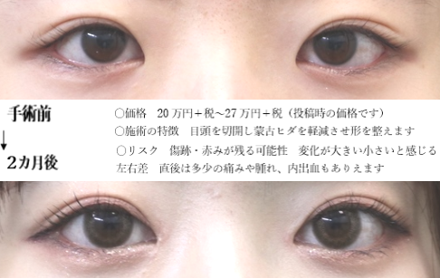 drmatsui's tweet photo. ヒダを減らし、白目を整えた例。
２か月後のお写真と比べてみます。
コンタクトが入って黒目が大きくなっても、白目が拡大する効果はおわかりいただけるのではないでしょうか。
＃目頭切開 https://t.co/vx3qkbDy3E