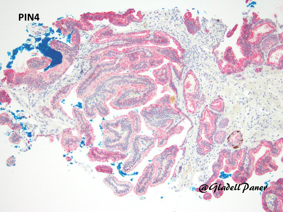 GladellPaner's tweet photo. Large gland #prostate cancer in needle biopsy. Would you call this …
Pseudohyperplastic Acinar adenocarcinoma or Ductal adenocarcinoma?
👉 Note pseudohyperplatic will be Gleason pattern 3 and ductal Gleason pattern 4.
#GrayZonePath #GUPath https://t.co/wGQYXI07jS