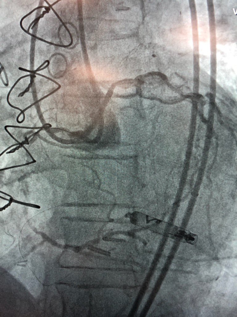 KeithNguyenSAIF's tweet photo. Antegrade rotashock cto intervention to the RCA. @SAIFSanAntonio https://t.co/ZsZszt53wG