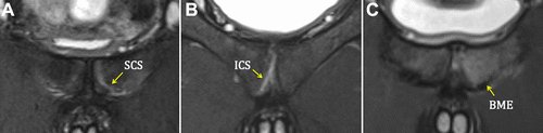 OJSM_SportsMed (@ojsm_sportsmed) on Twitter photo In patients with labral tears, cleft sign and bone marrow edema were seen more frequently in athletes versus nonathletes, especially contact athletes with FAI-related bony abnormalities.<a href="/WakasportsMed/">Wakamatsu SportsMed</a>
ow.ly/Li0a50IgqTa In patients with labral tears, cleft sign and bone marrow edema were seen more frequently in athletes versus nonathletes, especially contact athletes with FAI-related bony abnormalities.<a href="/WakasportsMed/">Wakamatsu SportsMed</a>
ow.ly/Li0a50IgqTa