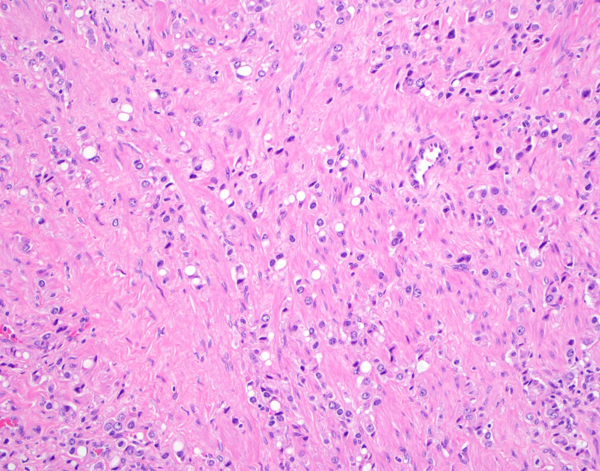 Andres_M_Acosta's tweet photo. Radical prostatectomy. Gleason 3+5=8 PCa? Or Grade Group 1 and Grade Group 5 PCa nodules inconveniently adjacent to each other? No clear transition well formed glands➡️poorly formed glands➡️single cells/files as described in PMID 30737469. #gupath #ProstateCancer #pathology https://t.co/y4wyRZQ8OP