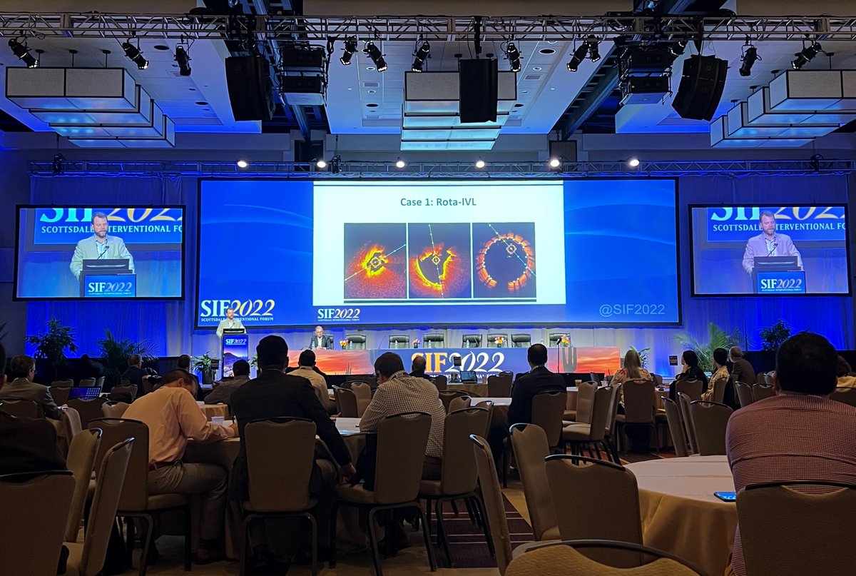 ShockwaveIVL's tweet image. Dr. @perc_surgeon presents severely calcified #RotaShock cases, including 1st #CoronaryIVL commercial case a year after the #ShockwaveC2 US commercial launch, at #SIF2022. “Coronary IVL is a dominant factor in calcium modification.”

ISI bit.ly/3iEq7fC @SIFCardiology