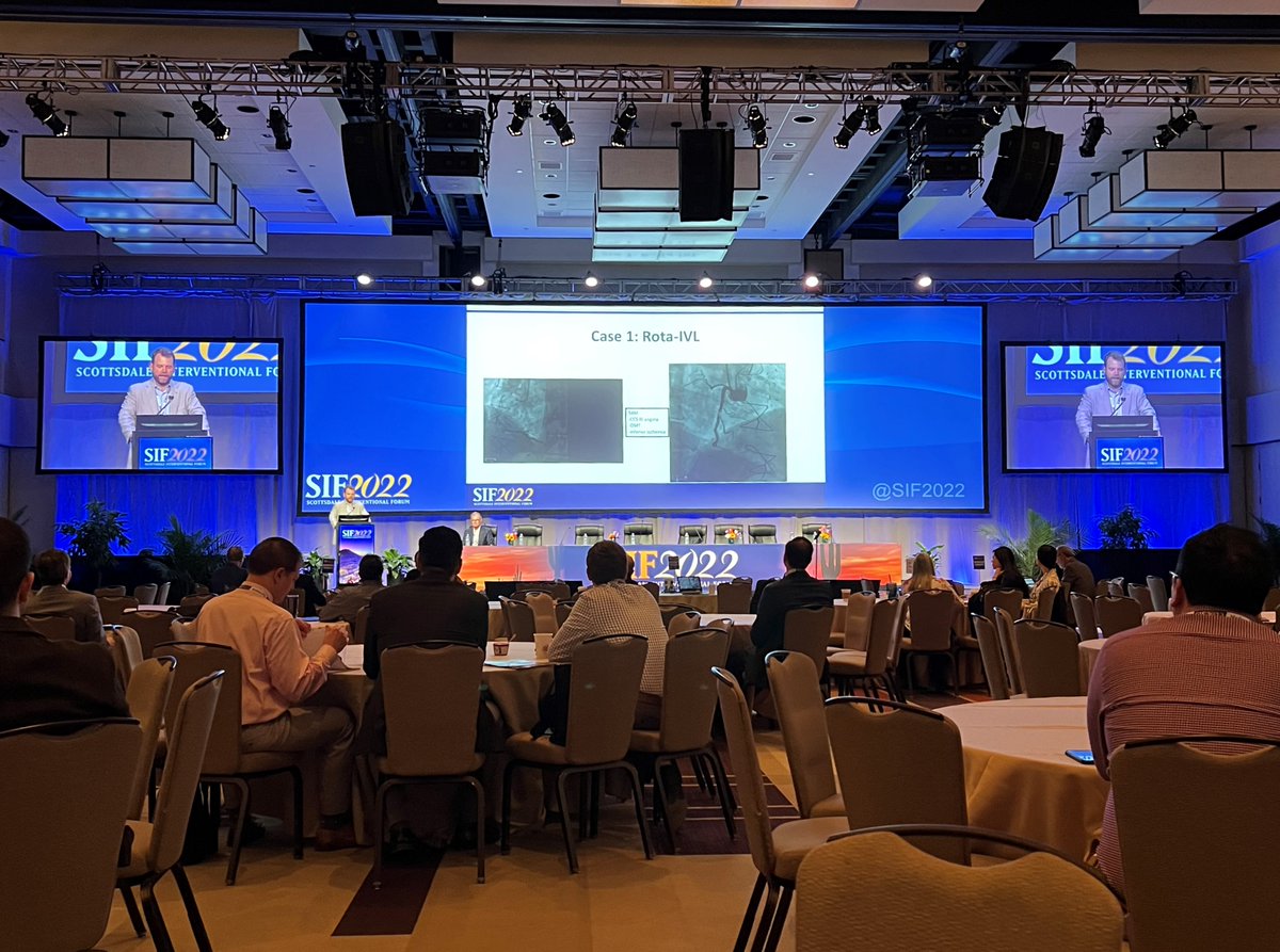 ShockwaveIVL's tweet image. Dr. @perc_surgeon presents severely calcified #RotaShock cases, including 1st #CoronaryIVL commercial case a year after the #ShockwaveC2 US commercial launch, at #SIF2022. “Coronary IVL is a dominant factor in calcium modification.”

ISI bit.ly/3iEq7fC @SIFCardiology