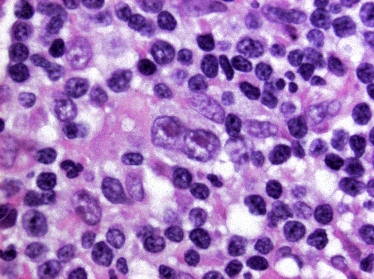 hemepathguy's tweet image. #hemepath Hodgkin cell is looking at you!