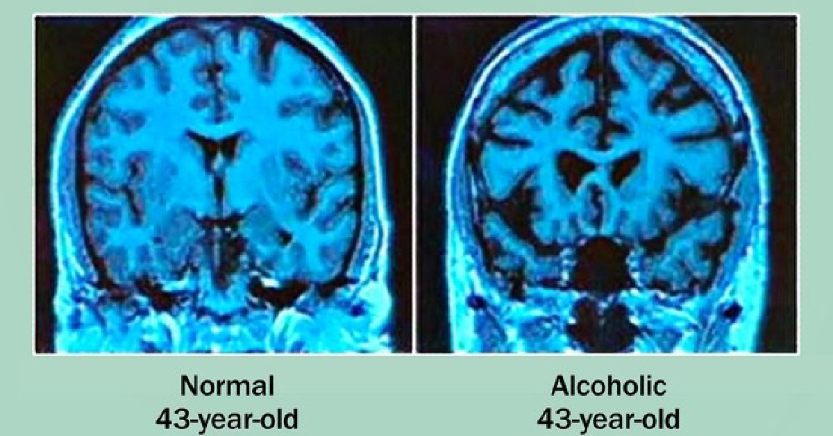 Too much alcohol can actually shrink your brain which can have big effects on your ability to think, learn, and remember things. wb.md/3tcaOQp