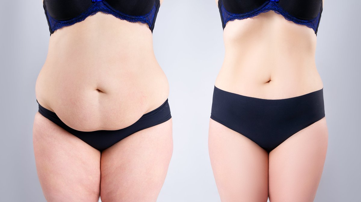A tummy tuck, known clinically as abdominoplasty, is a cosmetic procedure done to remove excess fat from the midsection to create a leaner physique. 

full article: bit.ly/362ZxJG

#tummytuck #plasticsurgery #cosmeticsurgery #silicone #gel #scars #biodermis