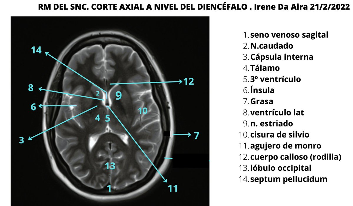 SanitariaR's tweet photo. Este trimestre hemos trabajado en clase imágenes de #resonancia 🧠
Hechas por alumn@s para alumn@s 🤩🤩🤩
#TSIDMN #anatomiaradioloxica_2022 https://t.co/yuarSgiKAh