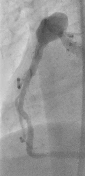 Mohamed Cherif Ijgua (@m_ijgua) on Twitter photo Postaneurysmal high-grade stenosis of
the right coronary artery in the cardiac CT with the corresponding findings of the coronary angiography before and after stenting. What a beautiful case! <a href="/Steph_Achenbach/">Stephan Achenbach</a> <a href="/M_Marwan_/">Mohamed Marwan</a> @monique_trobs <a href="/escardio/">European Society of Cardiology</a> <a href="/Heart_SCCT/">Heart_SCCT</a> Postaneurysmal high-grade stenosis of
the right coronary artery in the cardiac CT with the corresponding findings of the coronary angiography before and after stenting. What a beautiful case! <a href="/Steph_Achenbach/">Stephan Achenbach</a> <a href="/M_Marwan_/">Mohamed Marwan</a> @monique_trobs <a href="/escardio/">European Society of Cardiology</a> <a href="/Heart_SCCT/">Heart_SCCT</a>