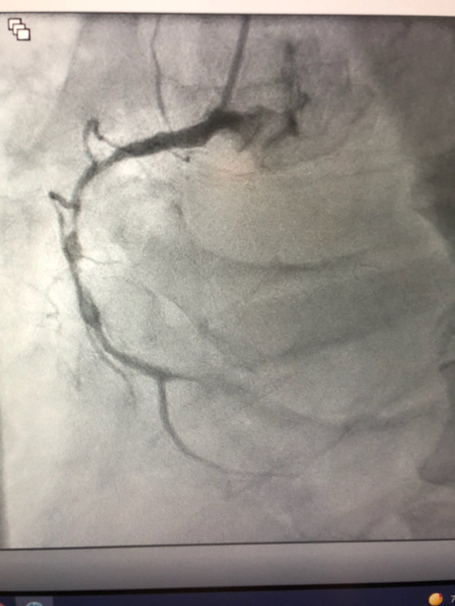 KeithNguyenSAIF's tweet photo. Antegrade cto Rota rca. @SAIFSanAntonio https://t.co/XTHUrWw3Wg