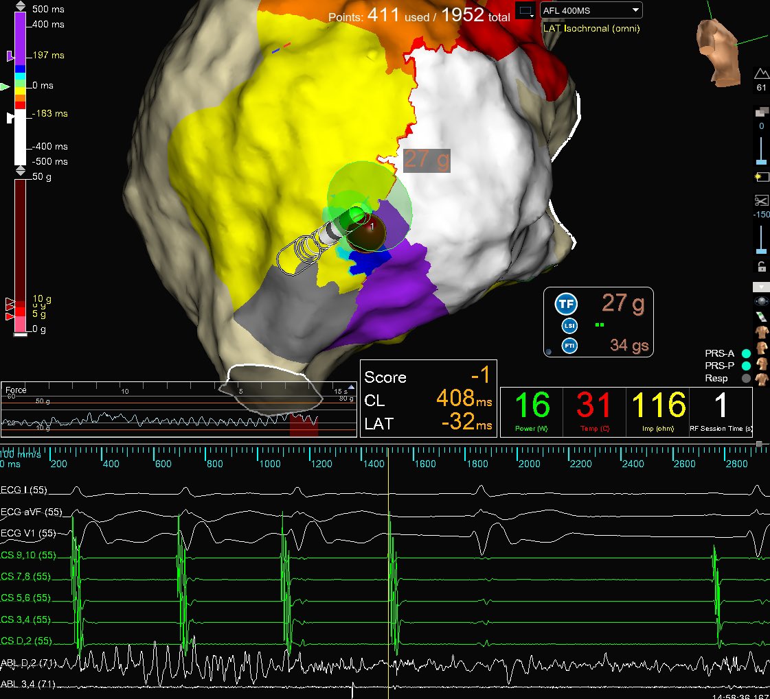Very cool Atypical AFL. #HDGrid captures entire TCL at area of isochronal crowding. #OT LAT on left vs. bipolar on right 😳. 1 second of RFA terminates &amp; renders SVT non-inducible. Excellent mapping &amp; ablation by <a href="/Dr_Markman/">Timothy Markman</a>. Map credit: <a href="/BrianOttoEP/">Brian Otto</a> <a href="/PennEPFellows/">Penn Electrophysiology Fellowship</a>  <a href="/AbbottCardio/">Abbott Cardiovascular</a>