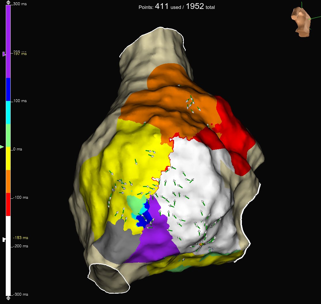 arcampado's tweet photo. Very cool Atypical AFL. #HDGrid captures entire TCL at area of isochronal crowding. #OT LAT on left vs. bipolar on right 😳. 1 second of RFA terminates &amp; renders SVT non-inducible. Excellent mapping &amp; ablation by @Dr_Markman. Map credit: @BrianOttoEP @PennEPFellows  @AbbottCardio https://t.co/WIzUIxEwpX