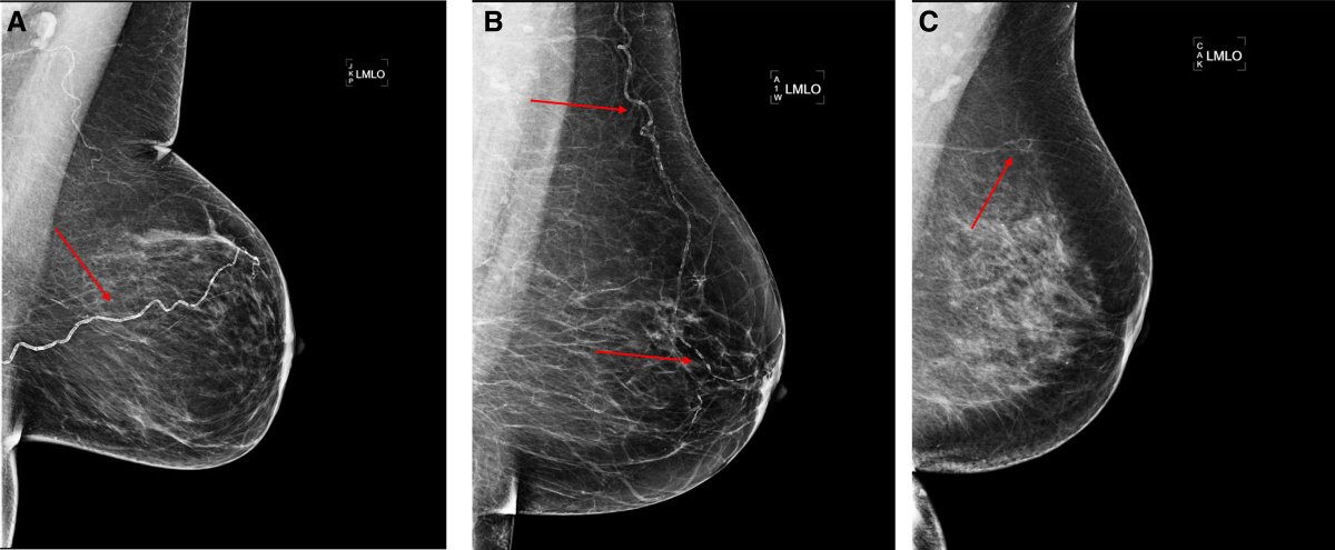 Dx_imaging's tweet photo. Study Shows Link Between Breast Arterial Calcification and Significant Cardiovascular Risks https://t.co/o9WlmOPhXf @BreastImaging @RSNA @RadiologyACR @AAWR_org @SIIM_Tweets @futureradres @ACRRFS @ACRYPS @MayoRadiologyAZ @WCMRadRes @USCBreastRads https://t.co/jk0wvnPfPC