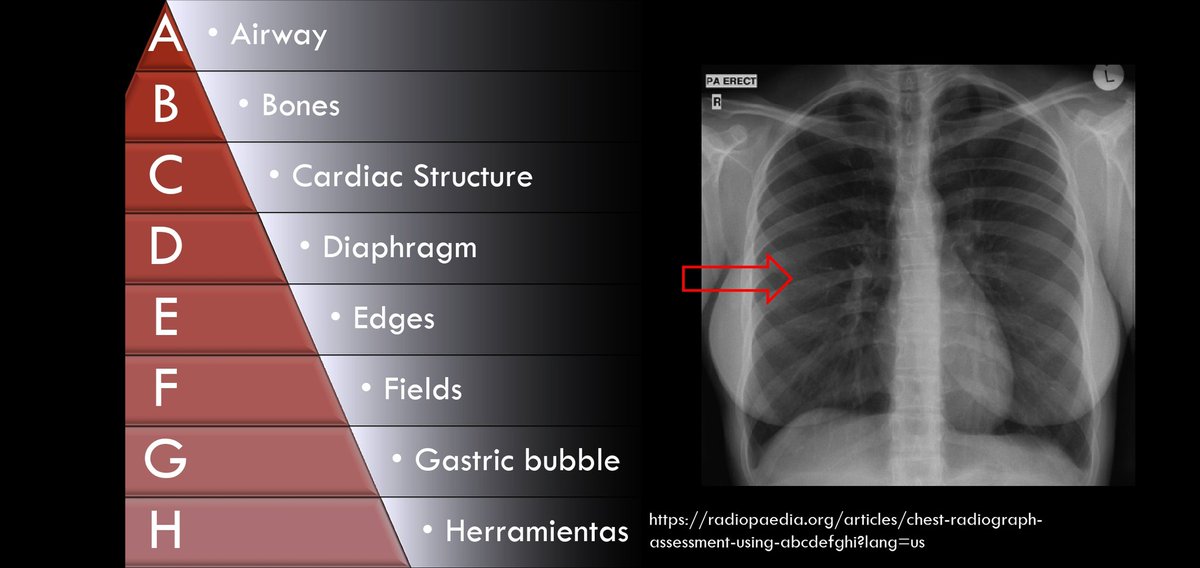 Sofade2ptos's tweet photo. La sesión de Radiología de hoy estuvo muy buena, les dejo mis 2 diapositivas favoritas
- Criterios para saber que una Rx PA Tórax es de calidad
- Orden de lectura propuesto para no saltarse partes.

(Créditos Dr Villalobos R1 Imagen) https://t.co/qPG4Wo3RtI