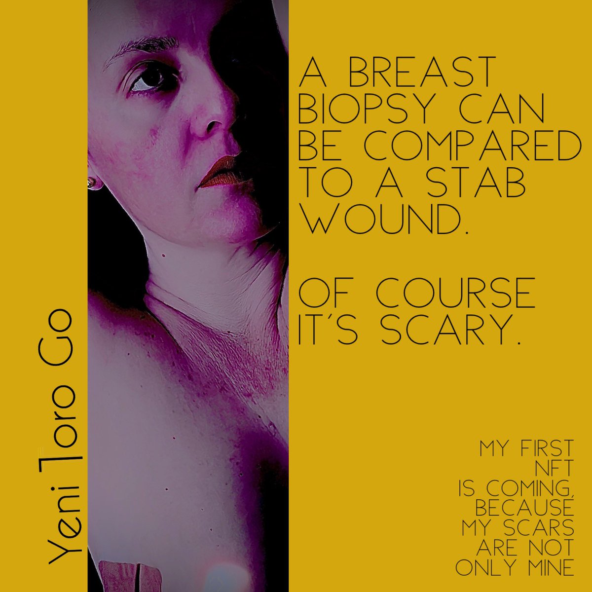 A #breastbiopsy is extremely painful, you need resting.  It’s not necessary to deceive ourselves to #feelstrong .  The pain is real and you need time to recover.  #NFT #breastcancer #womencancer #Etherum #ether #Status