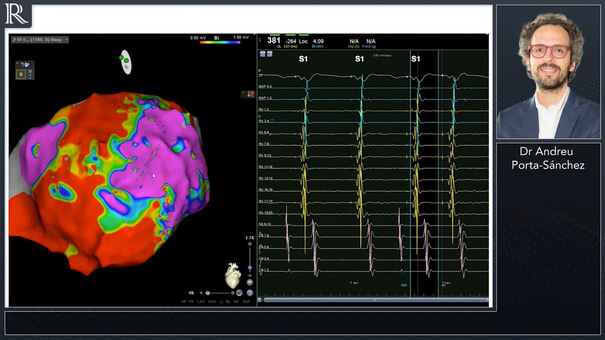 radcliffeCARDIO's tweet photo. Watch now as @aportasanchez provides Arrhythmia Academy with a concise and excellent ‘how-to’ overview of #DeEPMapping for VT substrate ablation in a challenging substrate.
#EPeeps
@AAuricchioMD @Dominik_Linz @DavidDuncker @DhirajGuptaBHRS
https://t.co/k52C5AuXQI https://t.co/EP07e3VOPt