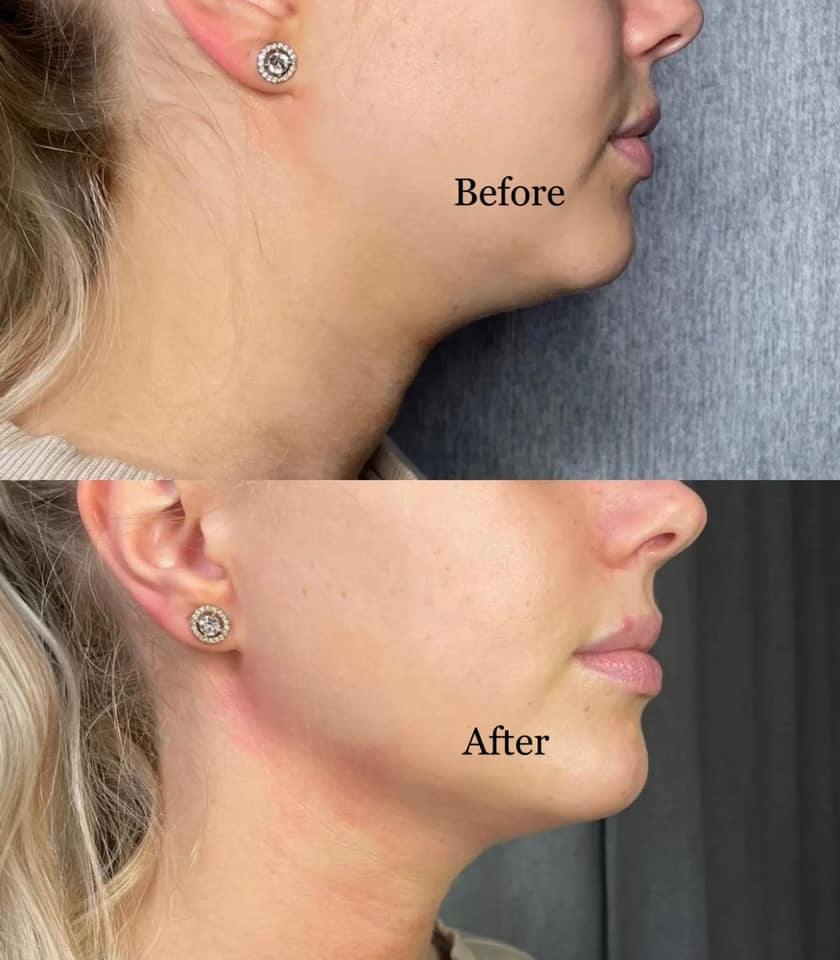 EVALASERTECH's tweet image. ✨✨7D HIFU DEVICE ONLY 1150USD✨✨
 Turn back the clock and look 10 years younger with the newest technology and newest generation of non-surgical lifting treatment with our 7D HIFU Treatment.

 Message us now for inquiries and order or contact us at 📲wa.me/8617710665224