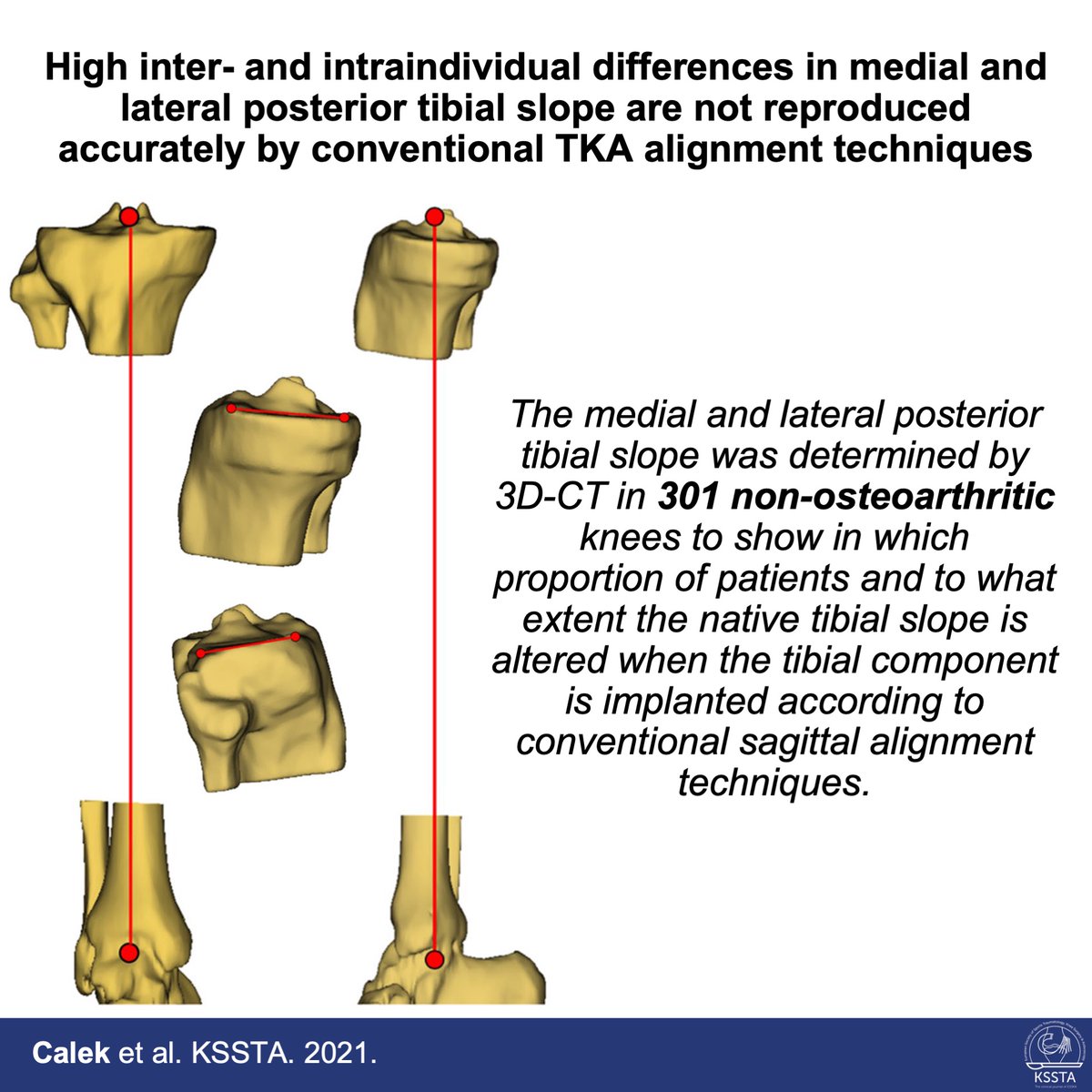 KSSTA's tweet photo. In 40% of TKA’s the anatomy of at least one compartment is changed more than 3°. This leads to an altered flexion and/or extension gap.

#sportstraumatology #TKA #knee #osteoarthritis #slope #arthroplasty #arthroscopyofknee #orthopaedic 

Reach here: https://t.co/RkphnXLe6E https://t.co/Ry2Mw2EeSD