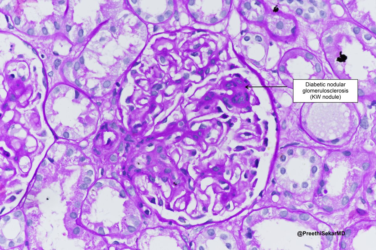 PreethiSekarMD's tweet photo. Elderly female with diabetes being evaluated for nephrotic syndrome (UPCR 9:1). 
Bx shows: Membranous nephropathy (PLA2R positive) along with diabetic nephropathy changes #renalpath #pathology https://t.co/mVkCZlv9I9
