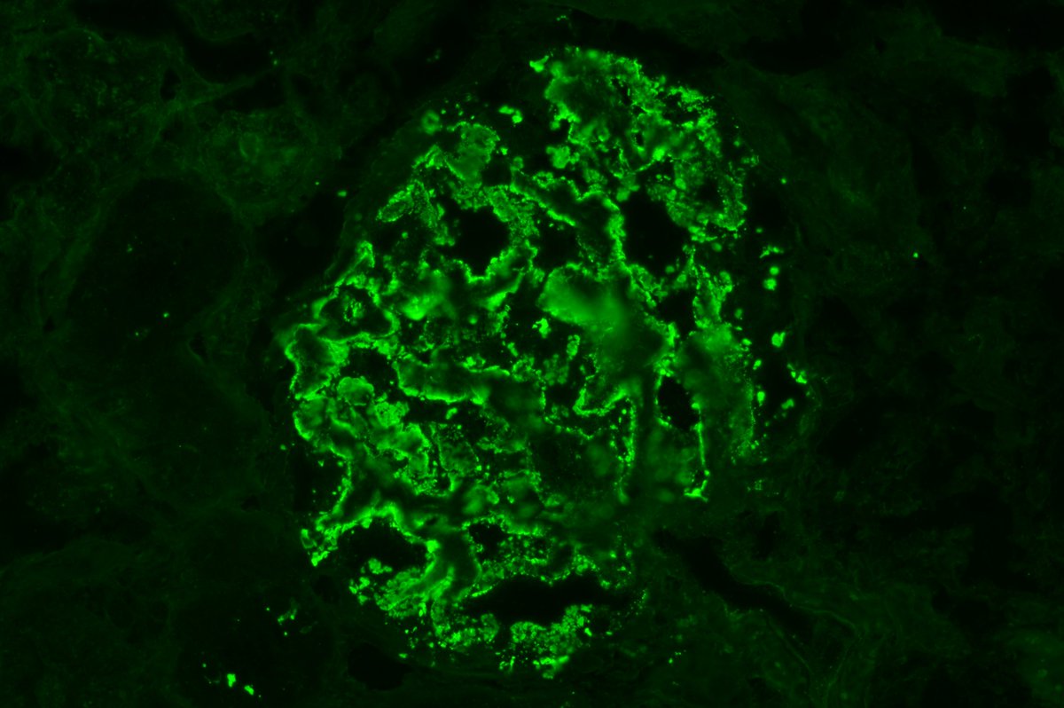 PreethiSekarMD's tweet photo. Elderly female with diabetes being evaluated for nephrotic syndrome (UPCR 9:1). 
Bx shows: Membranous nephropathy (PLA2R positive) along with diabetic nephropathy changes #renalpath #pathology https://t.co/mVkCZlv9I9