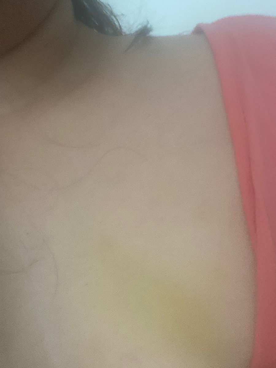 RattanMukherjee's tweet photo. 3 cont'd. On Indigo website and spoke to helpline to know that no complaint or report has been filed earlier and they will come back within 24 /48 hrs. This is highly irresponsible. We the parents stay at Kolkata and worried for her.She is in much pain . Pic enclosed. https://t.co/XJ6fqutdAr