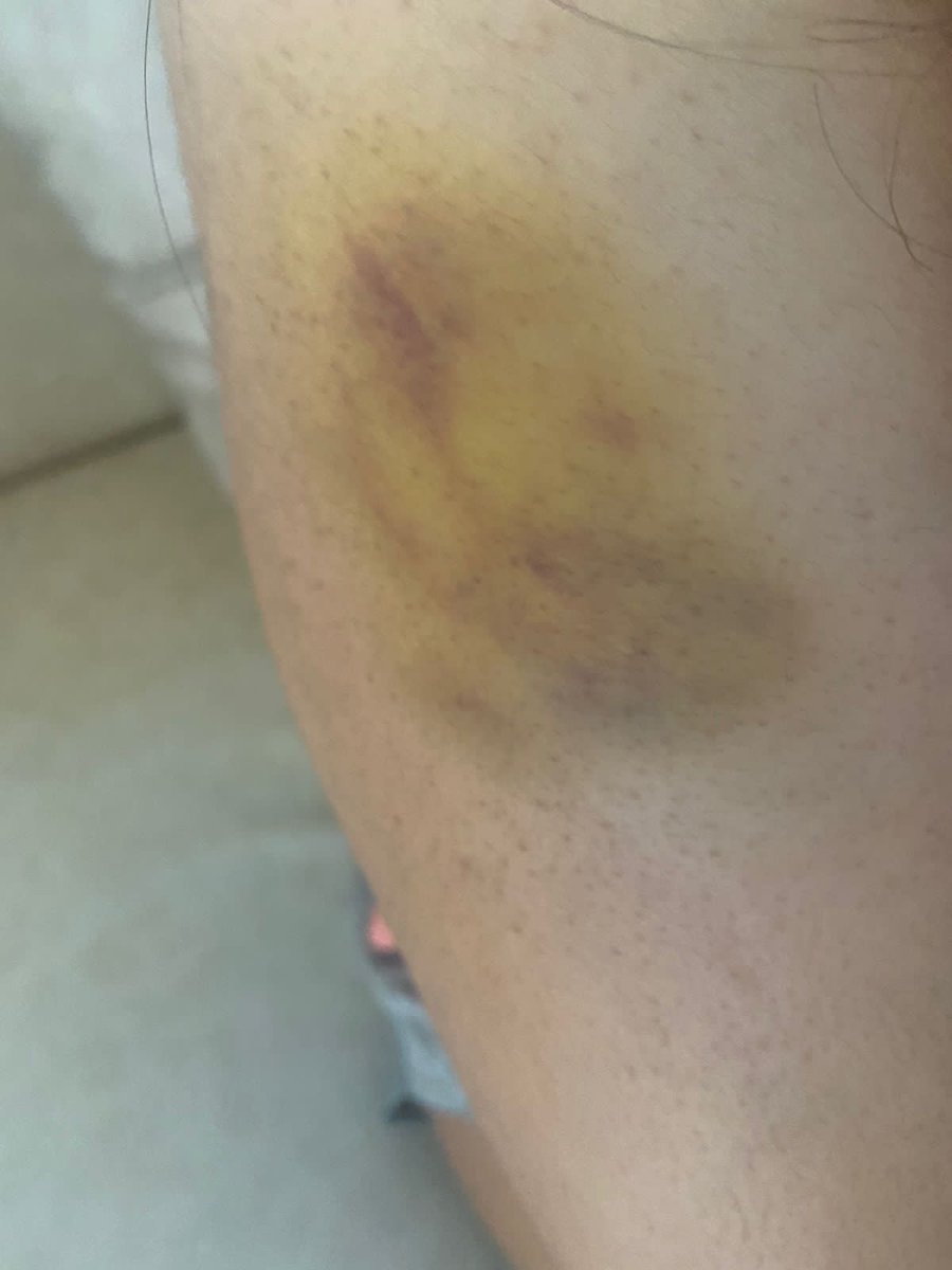 RattanMukherjee's tweet photo. 3 cont'd. On Indigo website and spoke to helpline to know that no complaint or report has been filed earlier and they will come back within 24 /48 hrs. This is highly irresponsible. We the parents stay at Kolkata and worried for her.She is in much pain . Pic enclosed. https://t.co/XJ6fqutdAr
