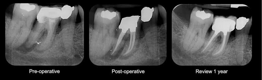 OMDENTALCLINICS's tweet photo. Single sitting root canal treatment

Gone are the ..For more info visit...https://t.co/qx4l1w8oFV https://t.co/sK3FTAPSxU