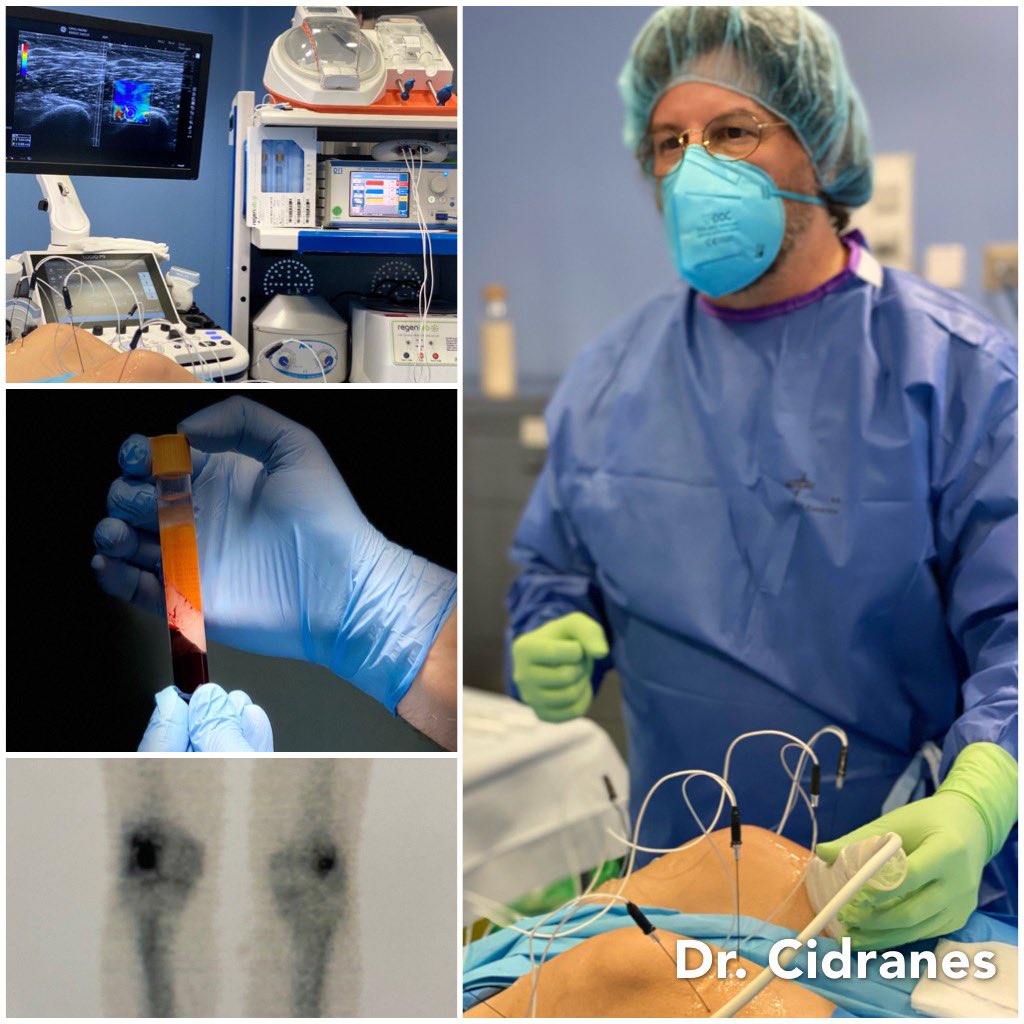 USAnesthesia's tweet photo. Knee Osteoarthritis ? 
Pain Management Unit 
@Vithas MADRID La Milagrosa 
.
Combined therapies after high resolution diagnoses.
#madrid #Chamberí #painrelief #painmanagement #gonalgia #gonartrosis https://t.co/YOYfjvlKIZ
