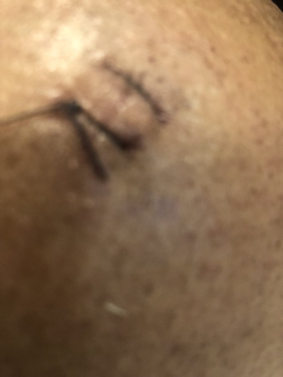 TheRealistMax's tweet photo. Shoulder surgery ✅ Painful, but on the mend💯#OneArmBandit https://t.co/6Ysb42jQIO