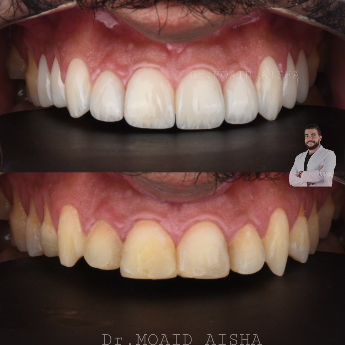drmoaid20's tweet photo. ابتسامة هوليوود 
مصنوعة من قشور الايماكس 3D باقل سماكه ممكنة لتفادي البروز 
اللون المختار BL3 https://t.co/rcRFHjvMTg