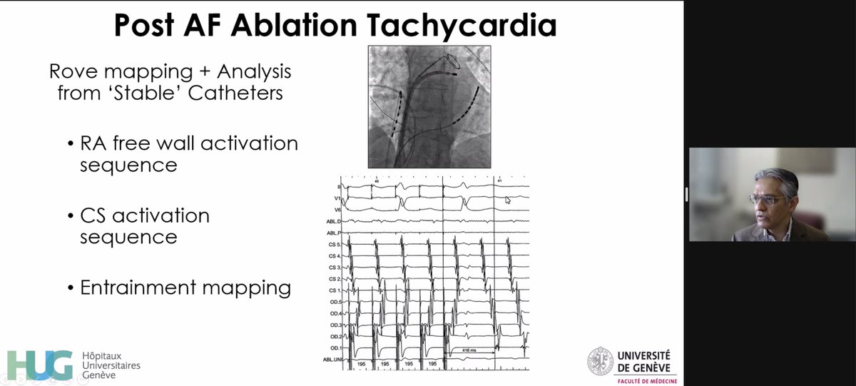 @AnneNeubert1 @BIOTRONIK_News @EPDeneke @Dominik_Linz @LaredoMikael @Rodrigo41353865 @Caerrhyn @iwanari65284818 @vhchong1 Importance of standardized setup to analyze atrial tachycardia post #AFablation and the „Wish list“ for atrial reentry of Prof. Dipen Shah! #IFPdigital