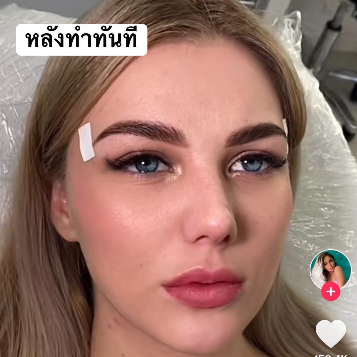 mintitapop's tweet image. วงการร้อยไหม ของ ประเทศ รัสเซีย นี่โหดสัสรัสเซียจริง จากคนหน้าอายุ 40-50
กลายเป็น 20-30 เลยอ่ะ นี่แคปมาจากคลิป คือ เขาไม่ได้แต่งรูปนะ ไม่แน่ใจว่า เป็นการร้อยไหมอย่างเดียวไหม น่าจะฉีดฟิลเลอร์+โบทอคด้วย แต่หน้าโคตรเปลี่ยน 100% (มีต่อ)