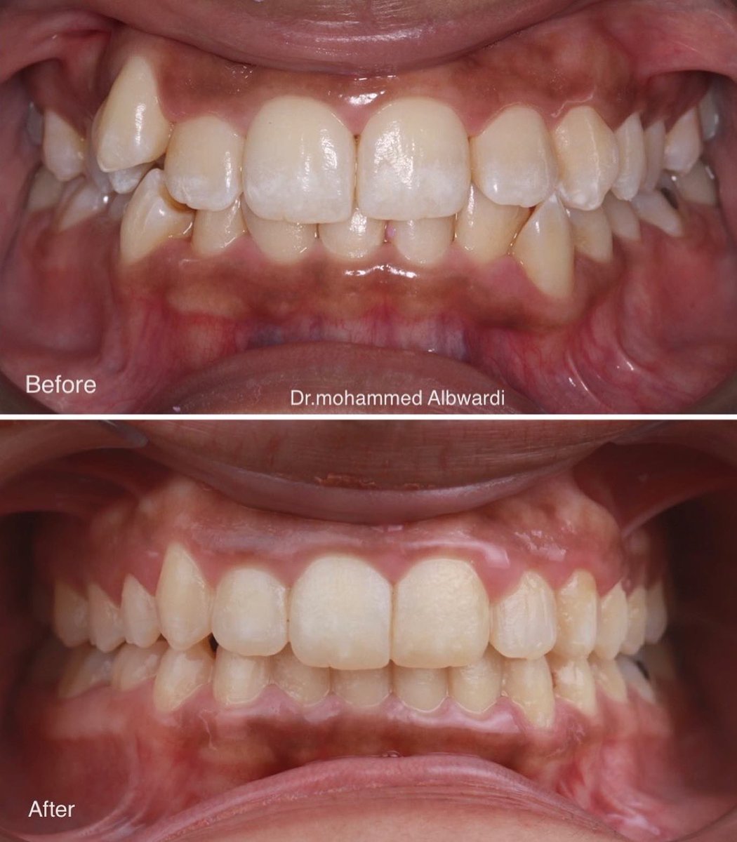 orthoclick's tweet photo. Invisalign case 

حالة تزاحم متوسطة تم العلاج باستخدام تقويم #الانفيزلاين بدون الحاجة للخلع والحصول على نتيجة مميزة. 
Moderate crowding case treated non extraction.

يلاحظ تحسن تطابق خط المنتصف. 

-
 
#invisaling https://t.co/qSLt0H5cFF