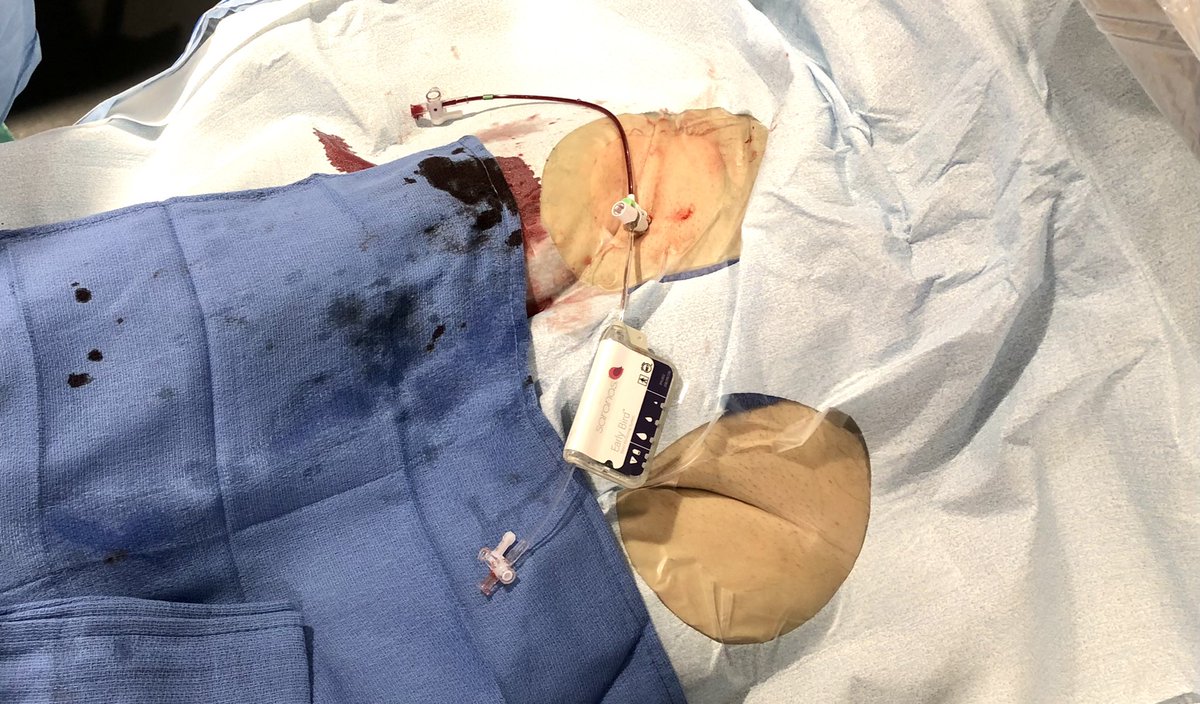 DrTomWaggoner's tweet photo. 74yo WM MVCAD, heavily calcified. Did Rota PCI single access #Impella CP. Use #EarlyBird. First Early Bird Early Bleeding in Tucson! This device could become very important with large bore arterial access SDD. #Safe-MCS trial @TAVRBot https://t.co/dfojW0qs18