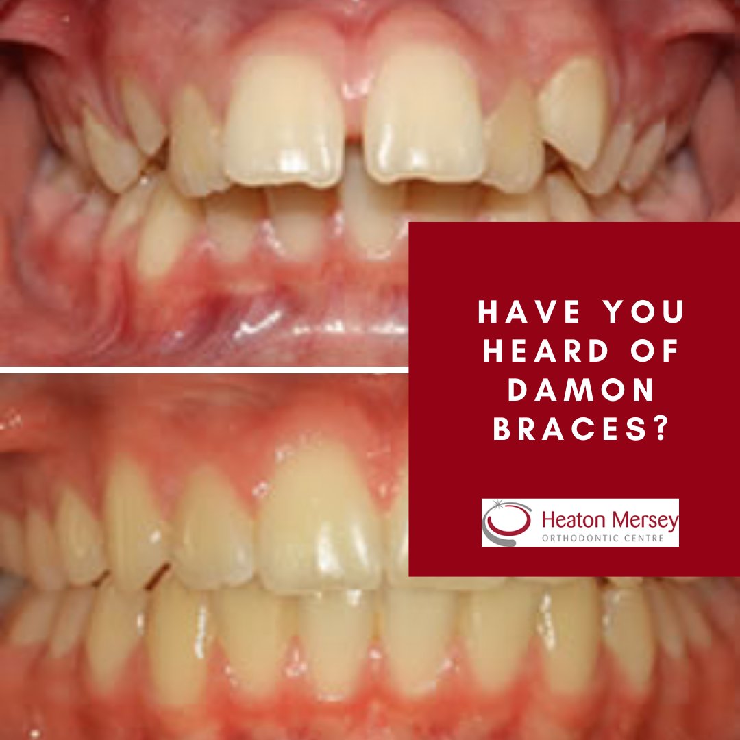 😁 They’re a great way to create a straighter, more uniform, more attractive smile.
They’re adjustable fixed braces, which get rid of the elastics and metal ties traditionally used in adult braces.
Message us for more information today! 📩
#DamonBraces #OrthodontistManchester