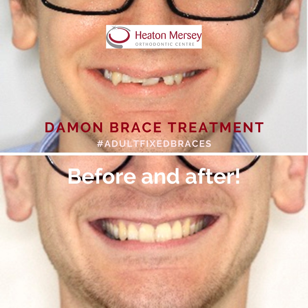 Winner of the Adult Fixed Braces category in the Aesthetic Dentistry awards 2021
I was very proud to have received recognition from my peers on the awards panel.
The end result exceeded both my and Jack’s expectations.