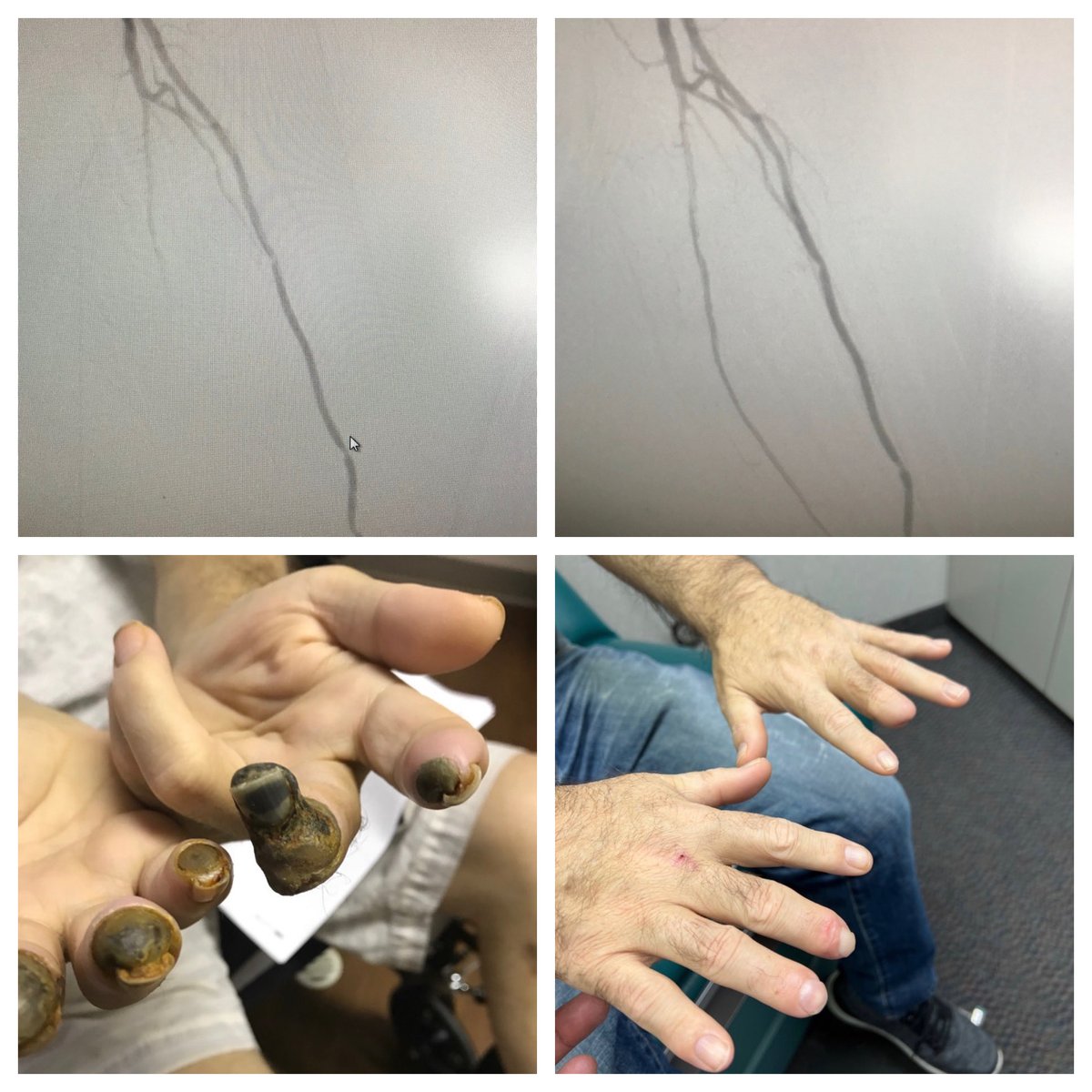 Luay sayed (@luaysayed) on Twitter photo 50yo DM,dialysis, digital gangrene rest pain.6 month post Bilat ulnar PTA.what a change! #cardiotwitter <a href="/ekgpdx/">Ethan Korngold, MD</a> <a href="/RajTayal2/">Raj Tayal</a>
<a href="/DrAmirKaki/">Amir Kaki, MD</a> <a href="/CLIfighters/">CLIfighters</a>
#ACCFIT @HadyLichaaMD@DrJayMohan
<a href="/chadialraies/">Chadi Alraies, MD FACC FSCAI</a> <a href="/BeaumontCards/">William Beaumont Hospital - Cardiology Fellowship</a>
<a href="/JayMathewsMD/">Jay Mathews MD, MS, FACC, FSCAI</a> <a href="/BaoGTran/">Bao Tran, MD</a>
<a href="/raatassi/">rafel atassi</a> <a href="/agtruesdell/">Alex Truesdell</a> 50yo DM,dialysis, digital gangrene rest pain.6 month post Bilat ulnar PTA.what a change! #cardiotwitter <a href="/ekgpdx/">Ethan Korngold, MD</a> <a href="/RajTayal2/">Raj Tayal</a>
<a href="/DrAmirKaki/">Amir Kaki, MD</a> <a href="/CLIfighters/">CLIfighters</a>
#ACCFIT @HadyLichaaMD@DrJayMohan
<a href="/chadialraies/">Chadi Alraies, MD FACC FSCAI</a> <a href="/BeaumontCards/">William Beaumont Hospital - Cardiology Fellowship</a>
<a href="/JayMathewsMD/">Jay Mathews MD, MS, FACC, FSCAI</a> <a href="/BaoGTran/">Bao Tran, MD</a>
<a href="/raatassi/">rafel atassi</a> <a href="/agtruesdell/">Alex Truesdell</a>