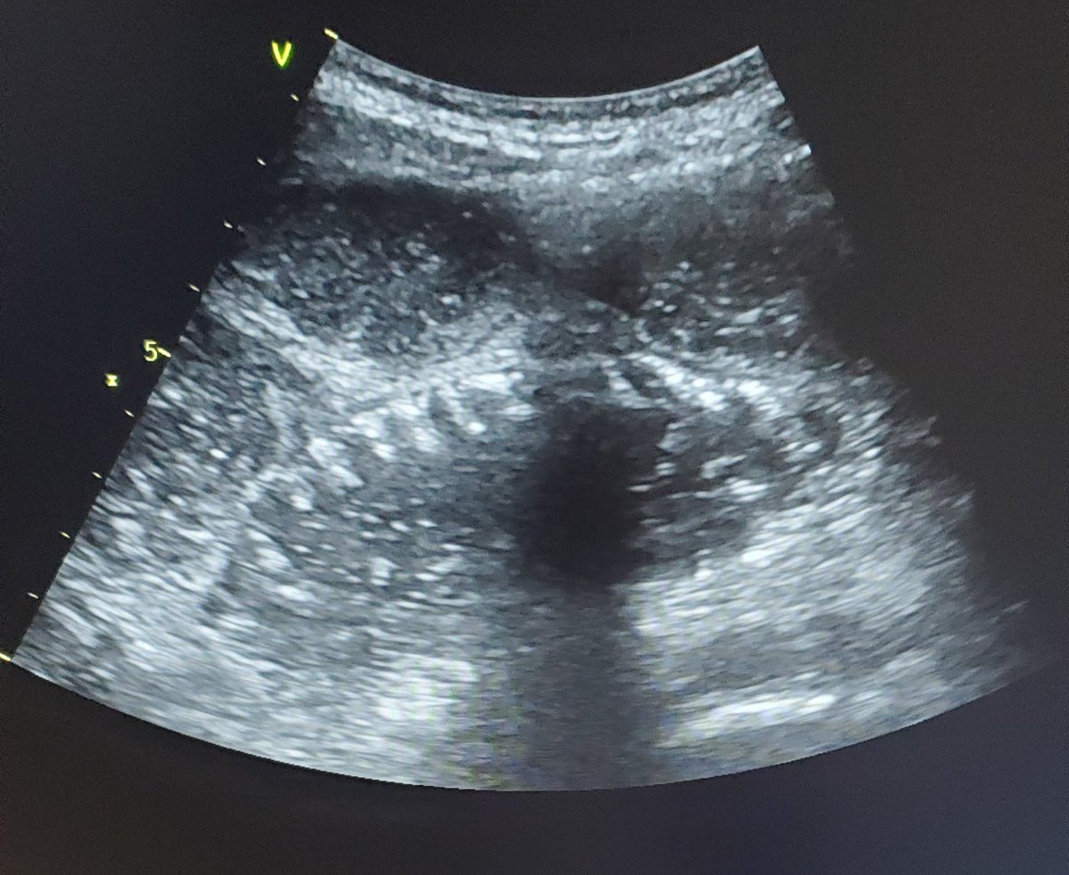 TheFrenchPOCUS's tweet photo. 45y.o man, complaining about "kidney stones, again...".
Me :
"Sir, this time, this isn't kidney stones" https://t.co/efroEnqWJi