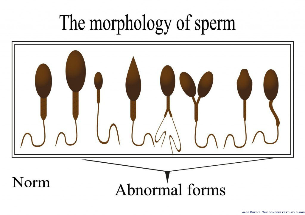 TopSexologist's tweet photo. Teratozoospermia refers to malformed shape of the sperms. Sperm morphology refers to the size and shape of the sperms and when the sperm morphology is defective, the condition is referred to as Teratozoospermia. 
https://t.co/2eHNFinofy

#FAQs #Teratozoospermia https://t.co/5BShv46ziW