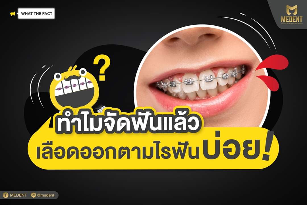 สงสัยมั้ยทำไมจัดฟันแล้วเลือดออกตามไรฟันบ่อย เป็นเพราะอะไร แล้วถ้าไม่อยากให้เหงือกเลือดออกต้องทำยังไง bit.ly/3iqBSoI