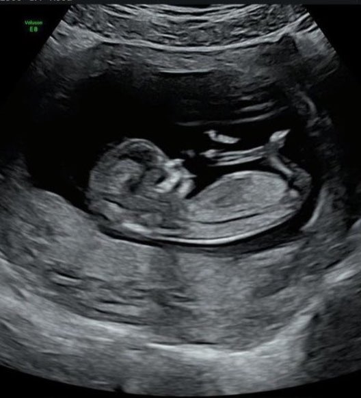 CynthiaMiaaou's tweet photo. ❤️🤰#HelloBaby 🤰❤️
Après des mois de silence, on s’est dit avec @TonyAma34964458 qu’il était temps de révéler notre secret 🤫 🗝😅
💗🌿 Le fruit de 7 ans d’amour 🙏🏻😌
#love #pregnant #20sa #babyiscoming #newlife #momtobe #dadvibes #parentstobe #lifegoals #couplegoals 💕 https://t.co/ACrc72wn0X